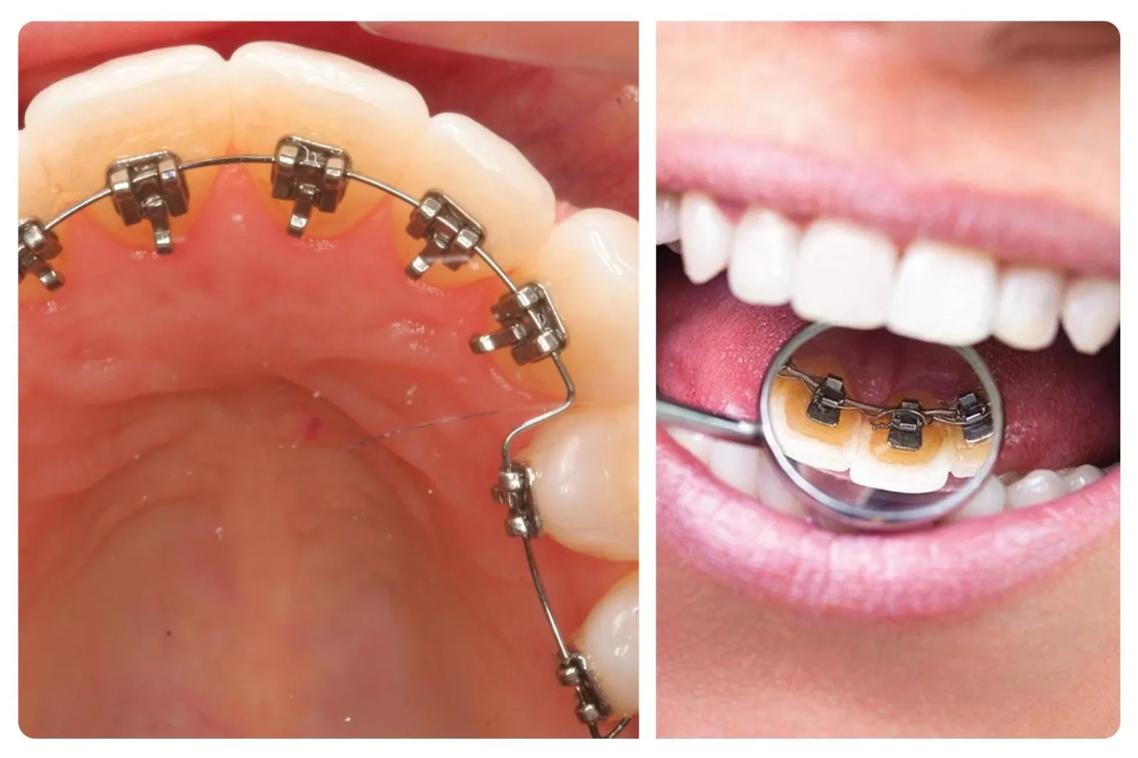 Niềng răng thẩm mỹ là gì? Lợi ích, quy trình và chi phí 11 3. Niềng răng bằng mắc cài mặt trong