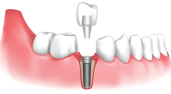 Cấy ghép implant mất bao lâu? Nha khoa Singae Dental