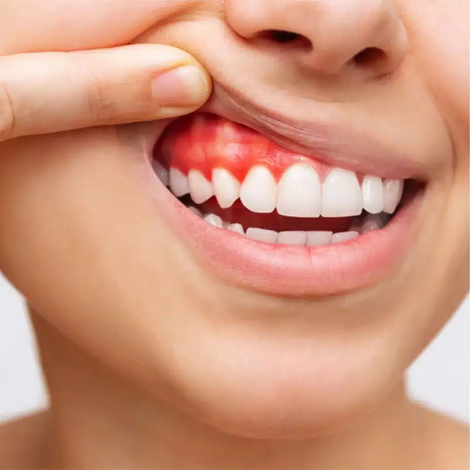 Niềng răng thẩm mỹ là gì? Lợi ích, quy trình và chi phí 8 Hạn chế nguy cơ các bệnh lý về răng miệng