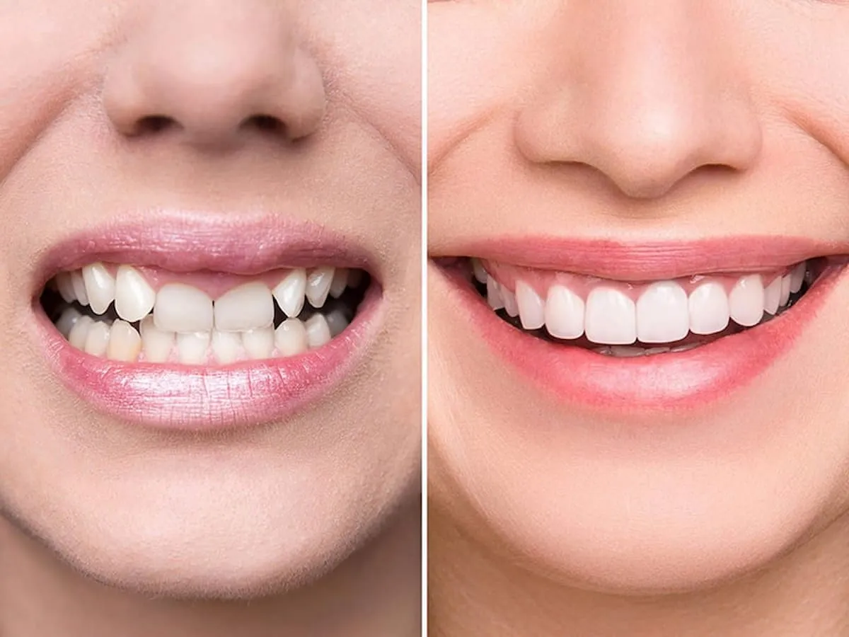 Bọc sứ răng hàm là gì? Khi nào cần bọc sứ răng hàm?