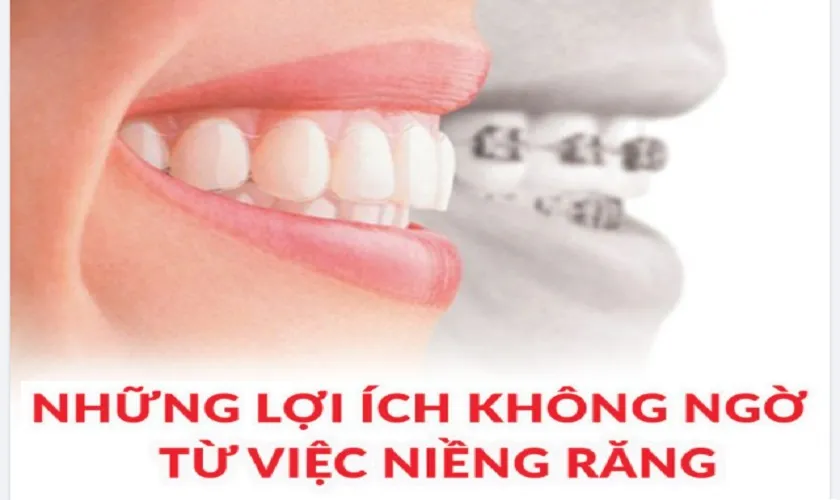 Niềng răng thẩm mỹ là gì? Lợi ích, quy trình và chi phí 7 LỢI ÍCH CỦA VIỆC NIỀNG RĂNG THẨM MỸ