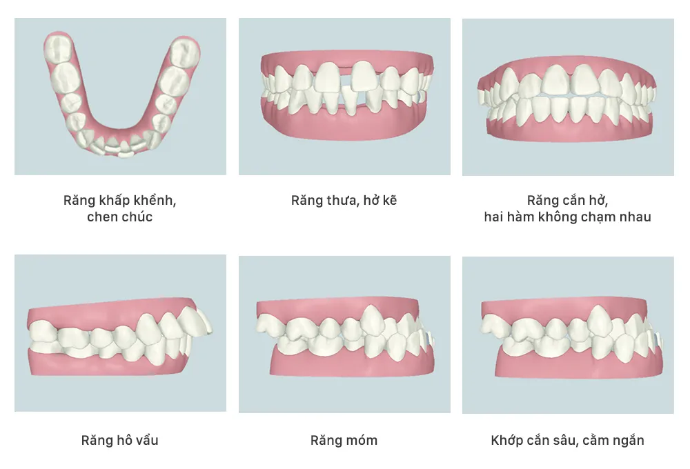 Niềng răng thẩm mỹ là gì? Lợi ích, quy trình và chi phí 9 NHỮNG TRƯỜNG HỢP CẦN THỰC HIỆN NIỀNG RĂNG THẨM MỸ
