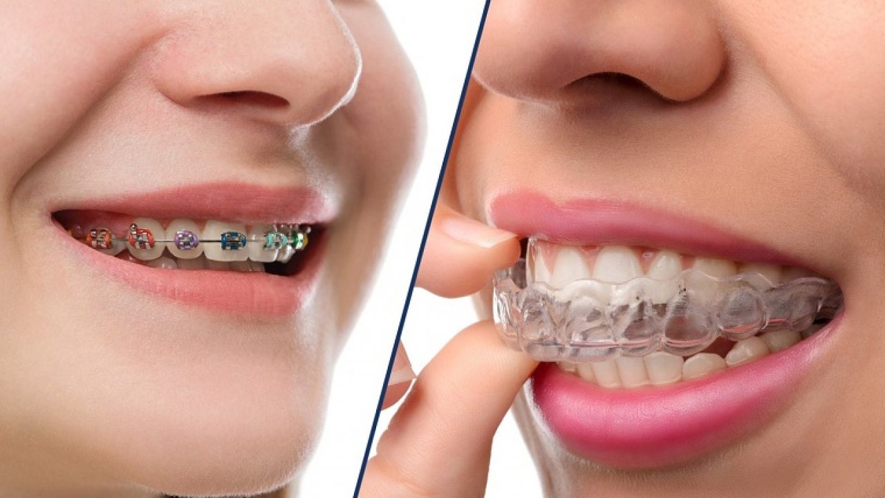 Niềng răng thẩm mỹ là gì? Lợi ích, quy trình và chi phí 12 4. Niềng răng Invisalign (khay chỉnh nha trong suốt)