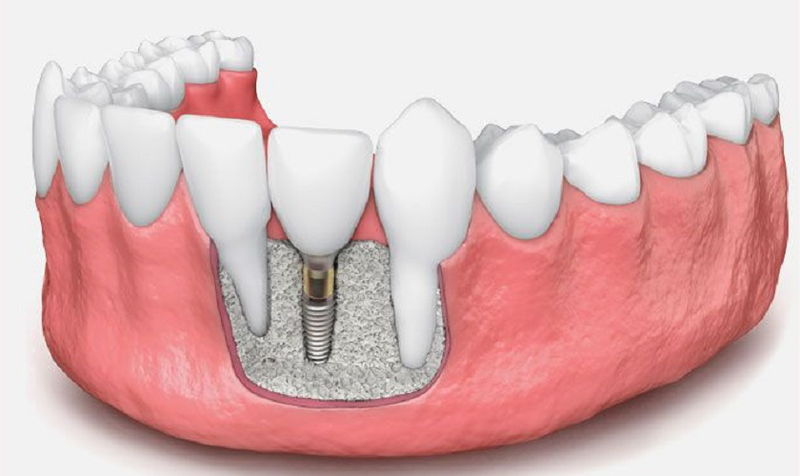 3. Thực hiện ghép xương