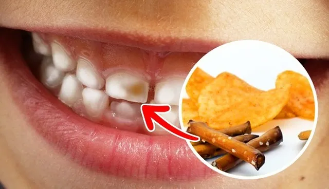 Cách vệ sinh răng miệng sau khi nhổ răng khôn chi tiêt 12 Tránh các loại thực phẩm gây hại