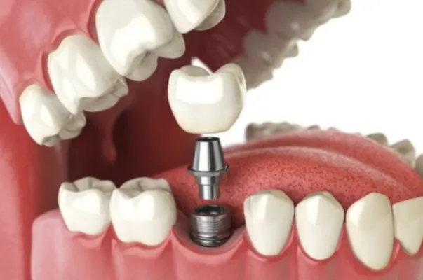 Trồng Implant răng cửa là gì? Quy trình thực hiện và lưu ý