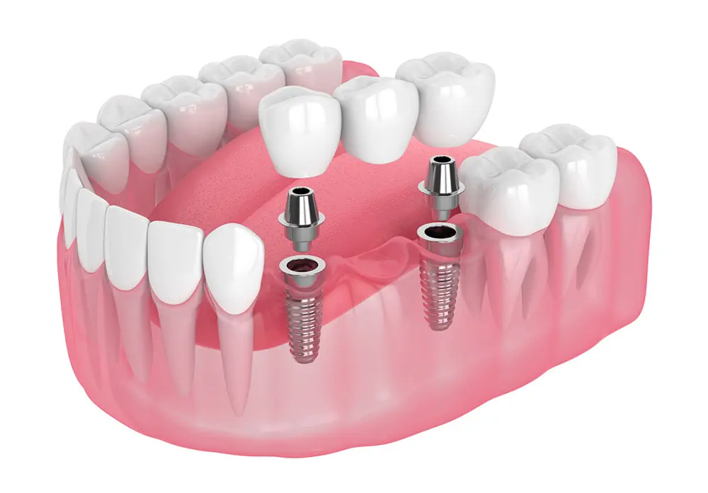 Trồng răng sứ cố định: Quy trình, các phương pháp và giá